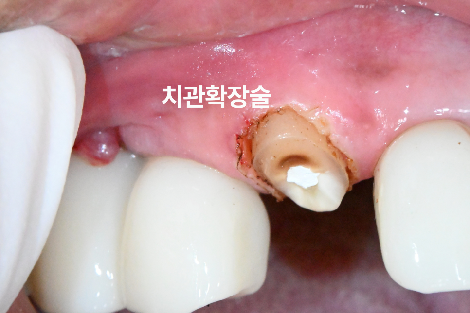 당산동 치과 앞니 파절 : 치관확장술이 필요할 수 있습니다. 관련 이미지 9