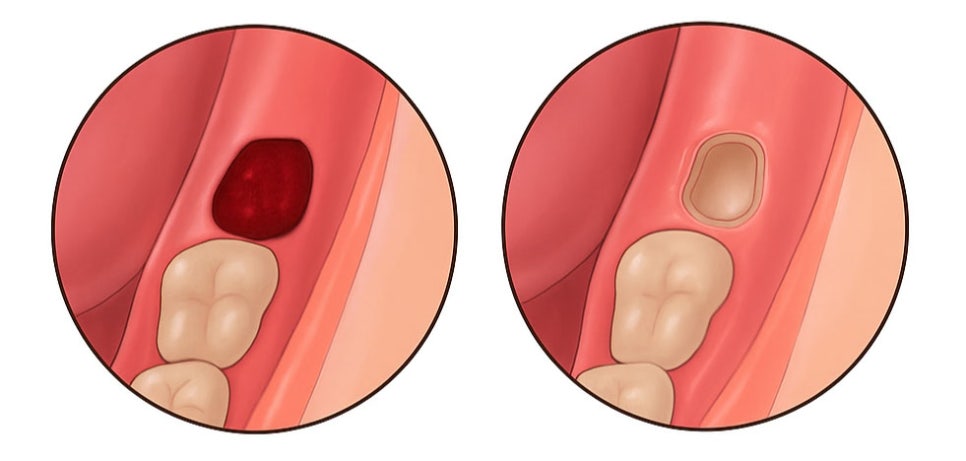 선유도역 치과 : 사랑니 발치 후 생길 수 있는 합병증, 어떻게 예방할 수 있을까? 관련 이미지 6