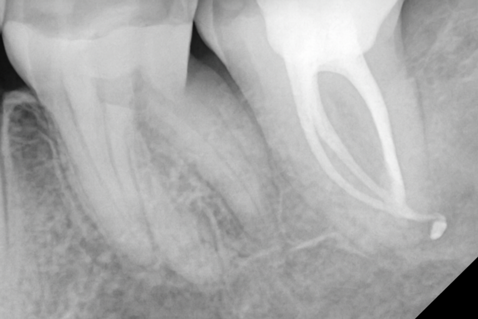 자연치 보존을 방해하는 C형 근관 : 당산동 치과 신경치료 관련 이미지 6