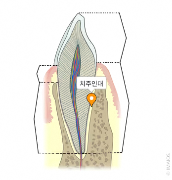 Seonyudo Station Dental Clinic Explains the Essential Steps to Take When a Tooth Is Injured image 2
