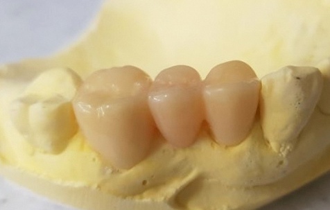 Why a Tooth Crown Is Needed After Root Canal Treatment at a Dental Clinic Near Yeongdeungpo-gu Office Station image 4