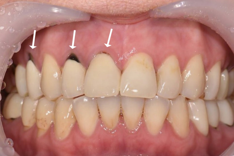 보철 밑에서 조용히 진행되는 2차 우식 - 레진 & 크라운 변연 미세누출 , 당산역 치과 관련 이미지 1