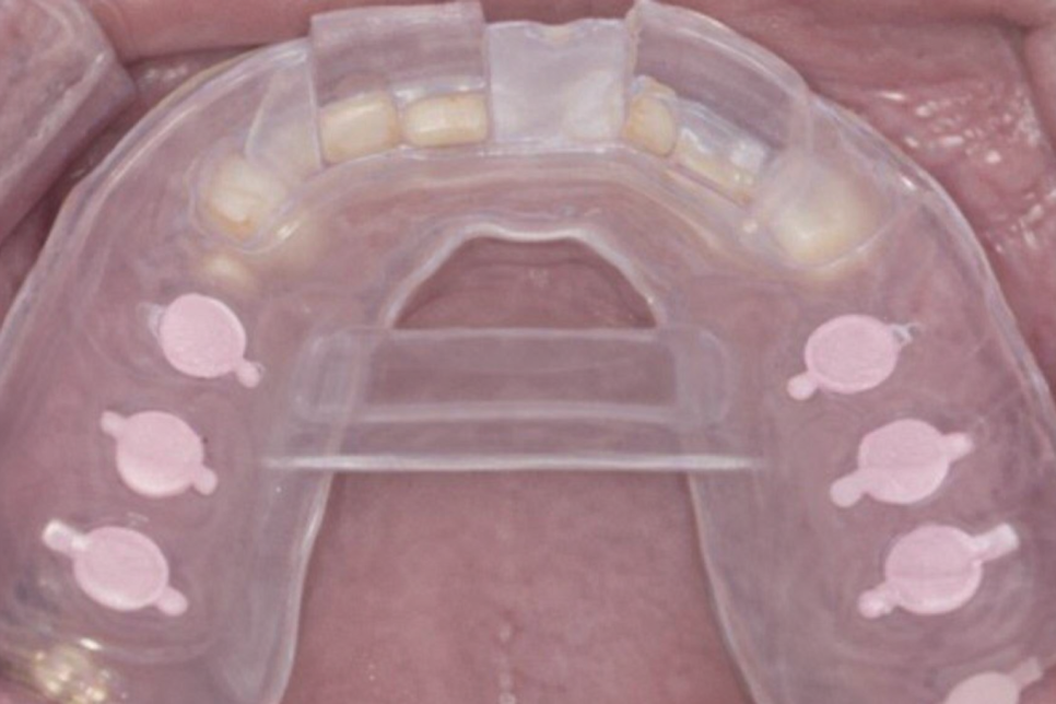 선유도역 치과 네이게이션 임플란트, 어떻게 진행될까? 관련 이미지 8