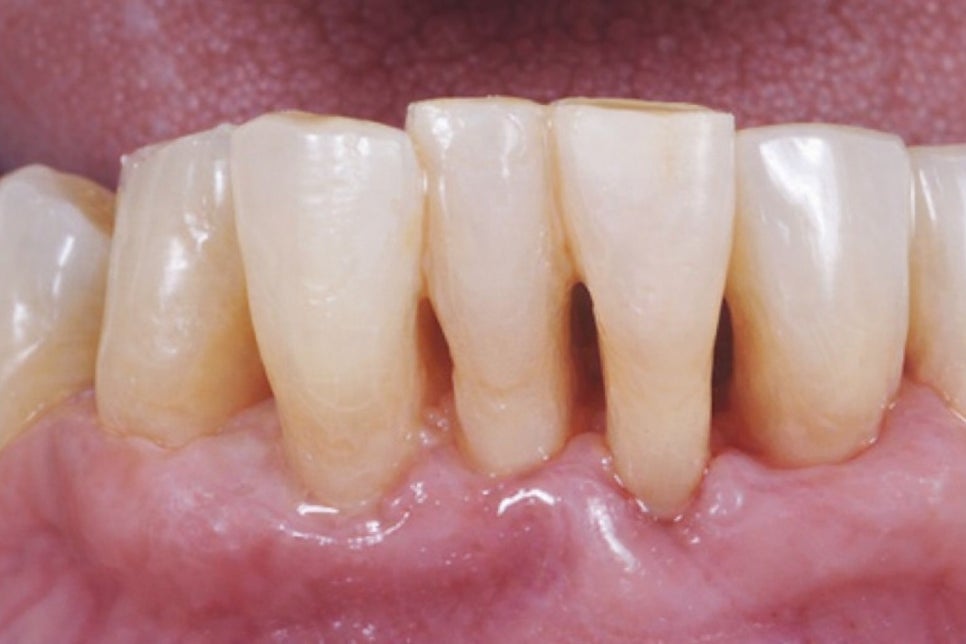 선유도역 치과 벌어진 앞니 다이아스테마 diastema 치료 방법 라미네이트 vs 레진 관련 이미지 2