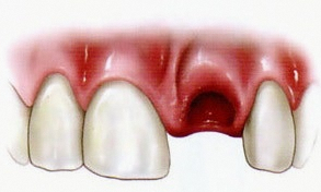 Seonyudo Station Dental Clinic Explains the Essential Steps to Take When a Tooth Is Injured image 1