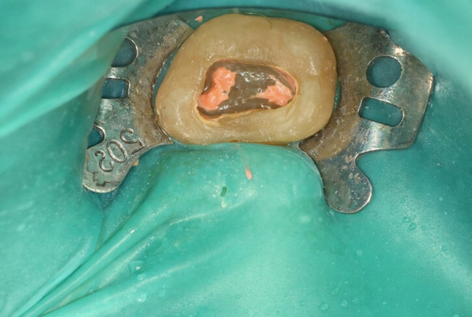 선유도 치과 재신경치료! 점점 커지는 치아 뿌리 염증 잡는 방법 관련 이미지 4