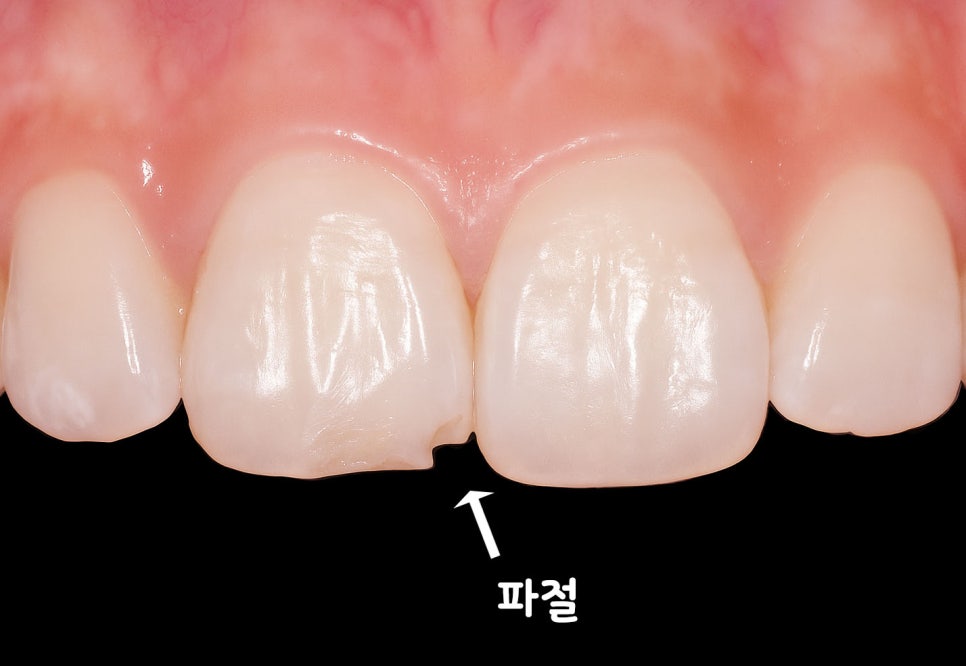 당산동 치과 : 레진 치료가 필요한 상황은 언제일까요? 초기 우식 & 앞니 벌어짐 & 파절 등 관련 이미지 5