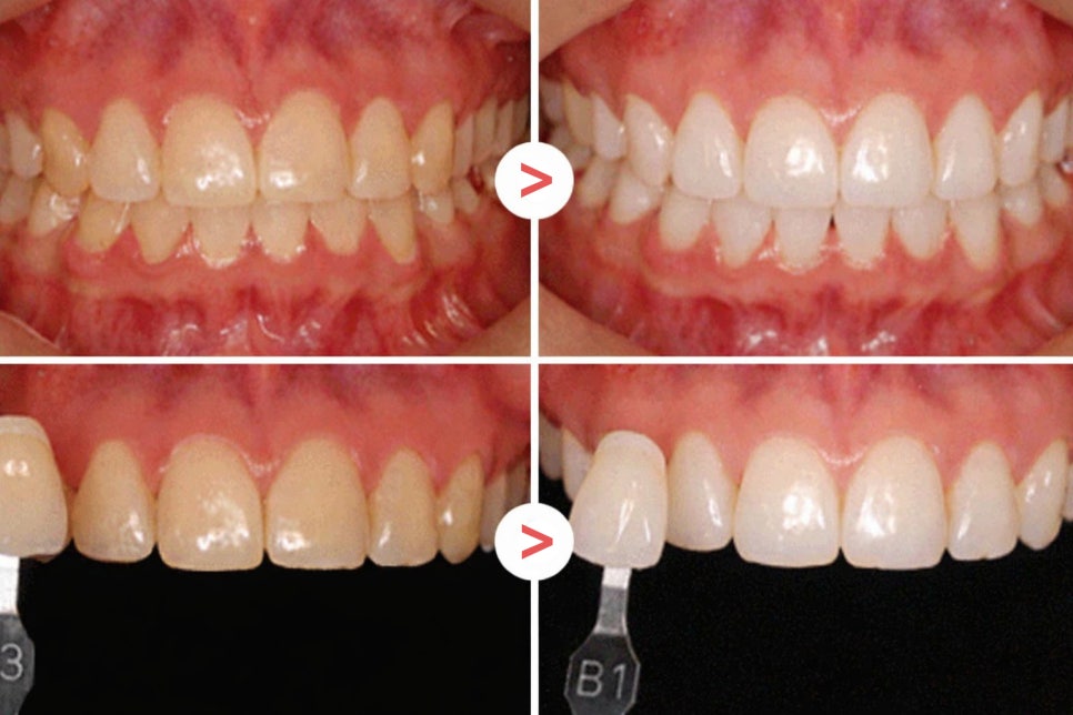 하얀 치아를 가지고 싶다면? 당산역 미백 치과 와 알아보는 시술 과정 관련 이미지 1