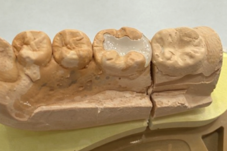 선유도역 치과 보존과 전문의가 설명하는 인레이 vs 온레이 차이점 관련 이미지 6