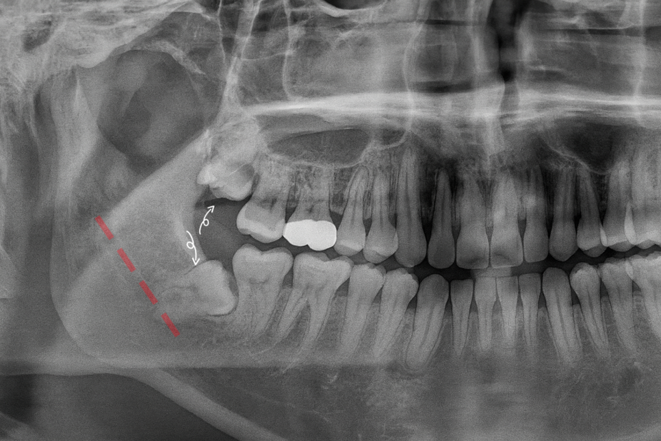 영등포동 치과 사랑니 발치 후 식사, 언제부터 가능할까? ft. 하치조 신경관 관련 이미지 2
