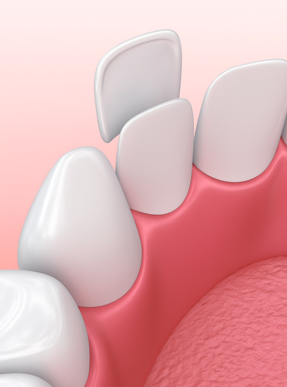 선유도역 치과 왜소치 라미네이트 VS 레진 수복 적합한 치료는?! 관련 이미지 4