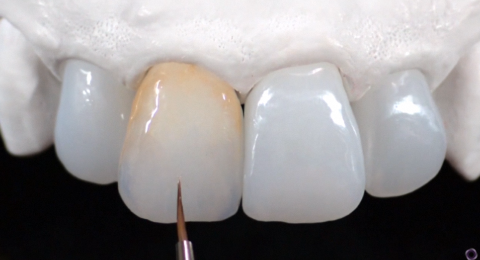 The Process of Creating Aesthetic Prosthetics Using a 3D Oral Scanner at the National Assembly Building Dental Clinic! image 5