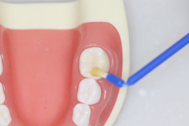 Yeongdeungpo Dental Clinic: Treatment Methods and Material Choices by Stage for Black Spots on Teeth image 5