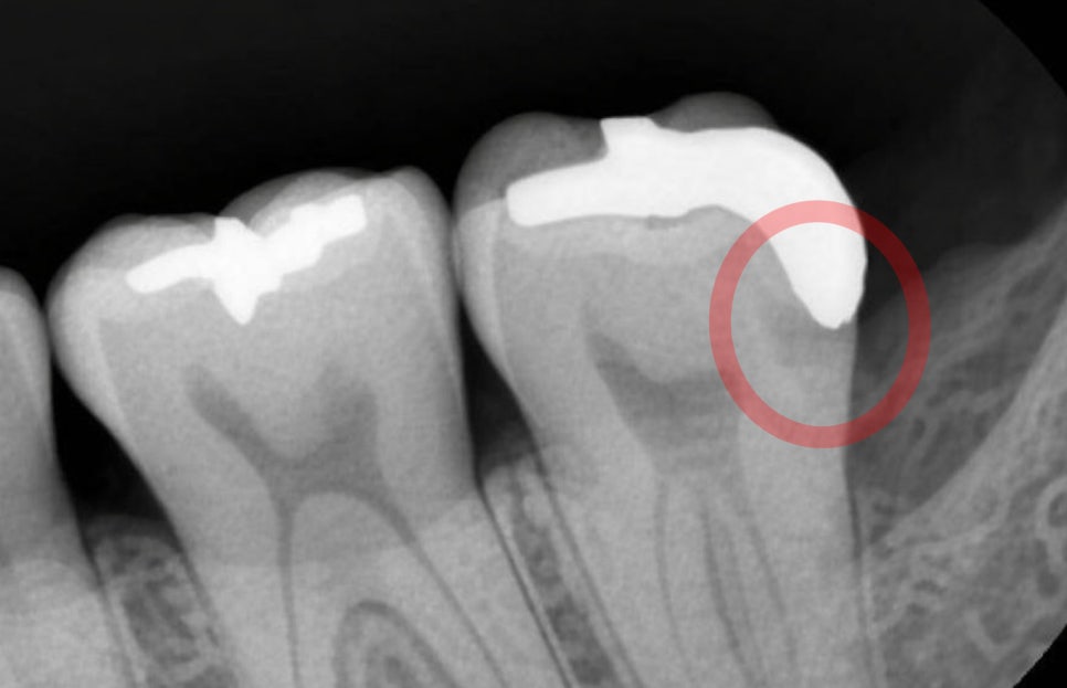 보철 밑에서 조용히 진행되는 2차 우식 - 레진 & 크라운 변연 미세누출 , 당산역 치과 관련 이미지 6