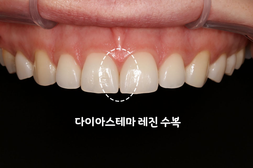 당산동 치과 : 레진 치료가 필요한 상황은 언제일까요? 초기 우식 & 앞니 벌어짐 & 파절 등 관련 이미지 7