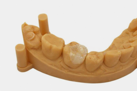 선유도역 치과 보존과 전문의가 설명하는 인레이 vs 온레이 차이점 관련 이미지 5