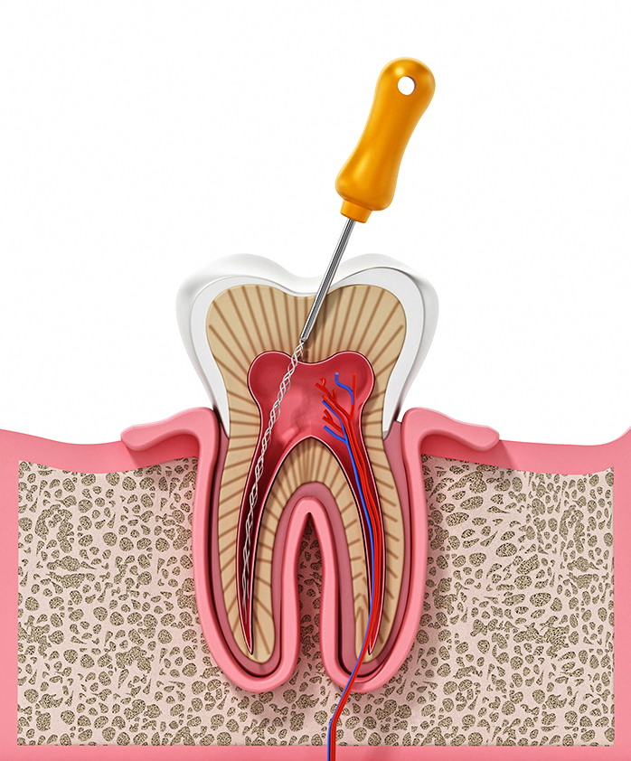 Does a Tooth Fracture at a Dangsan-dong Dental Clinic Always Require Root Canal Treatment? image 4