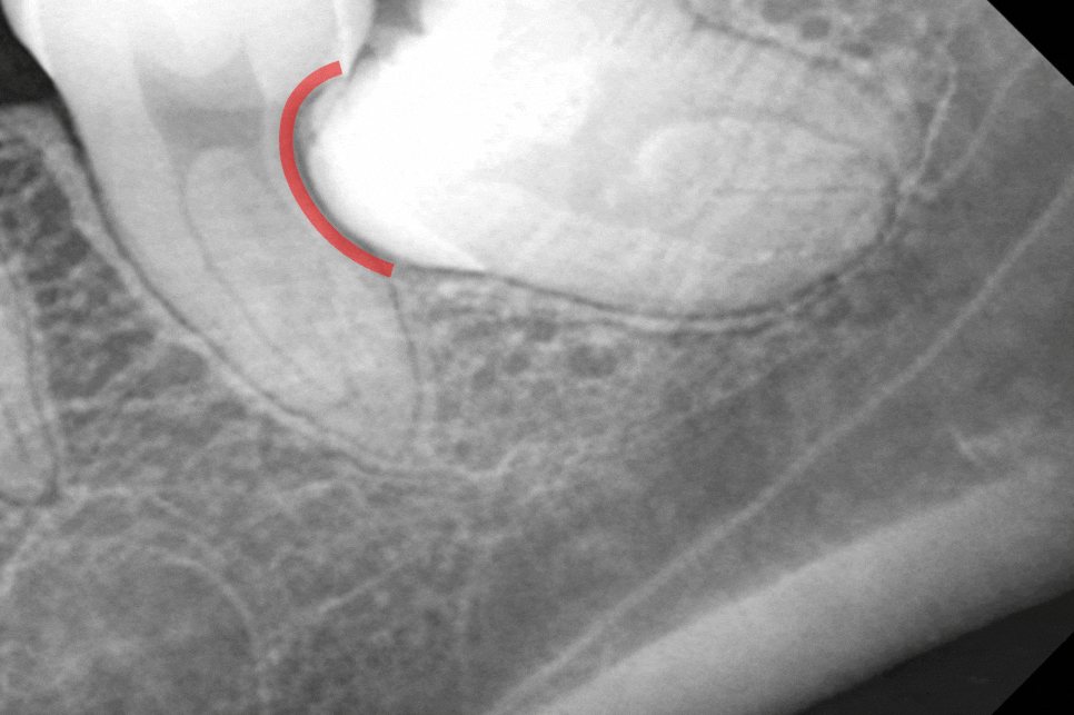 수평 매복 사랑니 예방적 발치가 필요할 때는? 선유도역 치과 Ft. 인접치 우식 & 치조골 흡수 등 관련 이미지 5