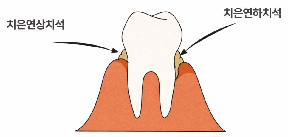 당산 치과 치은연하치석이란? 주기적으로 스케일링 받아야 되는 이유! 관련 이미지 1