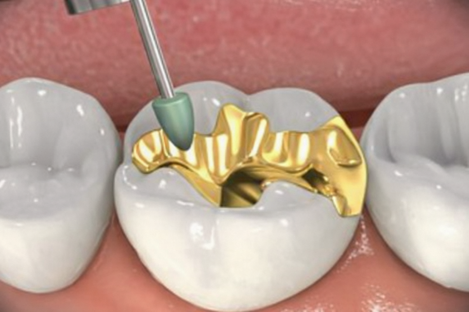 선유도역 치과 보존과 전문의가 설명하는 인레이 vs 온레이 차이점 관련 이미지 7
