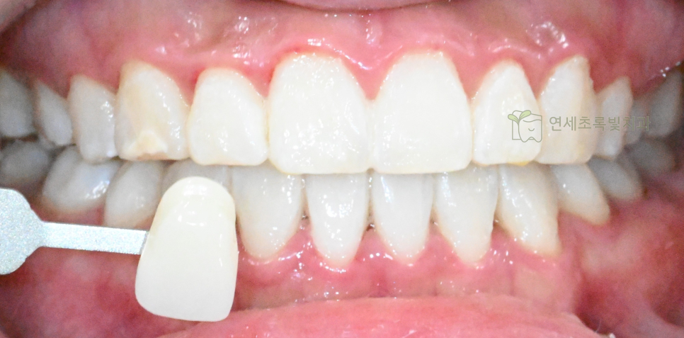 당산동 치과 원데이 화이트닝, 미백 치약보다 효능 확실한 이유는?! 관련 이미지 2