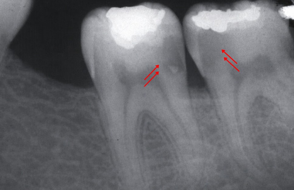 보철 밑에서 조용히 진행되는 2차 우식 - 레진 & 크라운 변연 미세누출 , 당산역 치과 관련 이미지 5