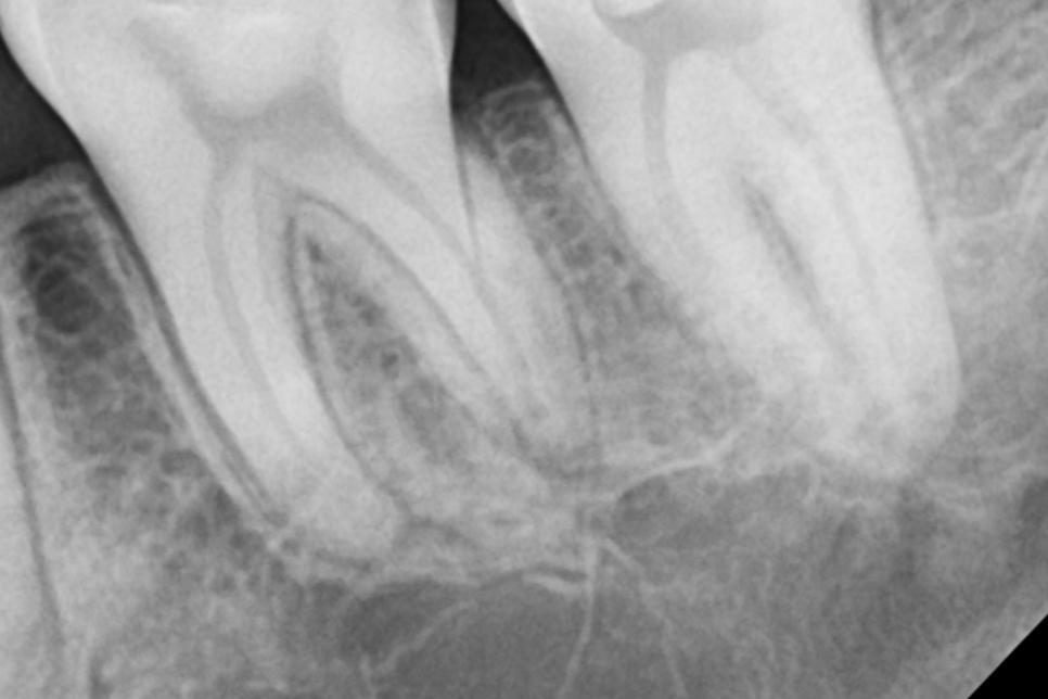 자연치 보존을 방해하는 C형 근관 : 당산동 치과 신경치료 관련 이미지 5