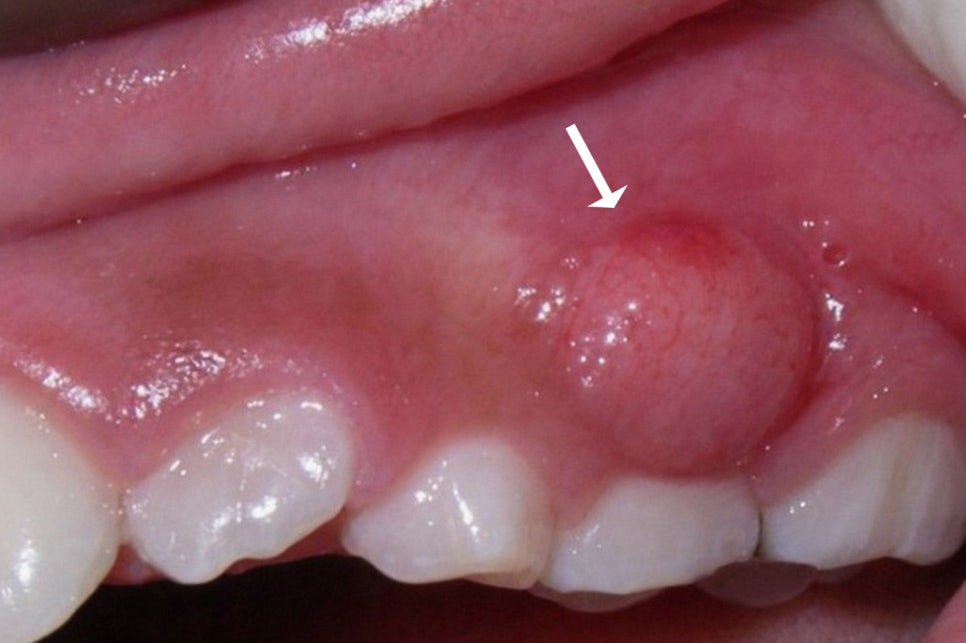 선유도 치과 재신경치료! 점점 커지는 치아 뿌리 염증 잡는 방법 관련 이미지 2
