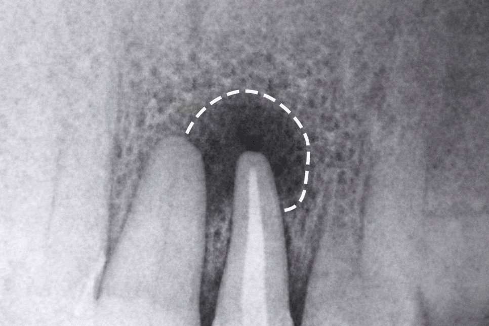 선유도 치과 재신경치료! 점점 커지는 치아 뿌리 염증 잡는 방법 관련 이미지 1