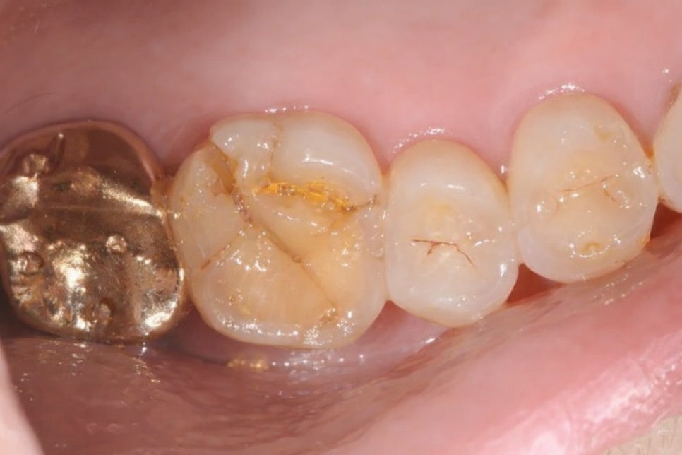 치아 크랙 방치하면 안 되는 이유 파절 증상부터 원인까지 당산 보존치과 에서 알려드립니다! 관련 이미지 1