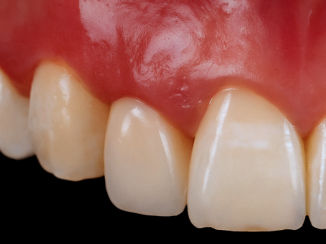 선유도역 치과 왜소치 라미네이트 VS 레진 수복 적합한 치료는?! 관련 이미지 6