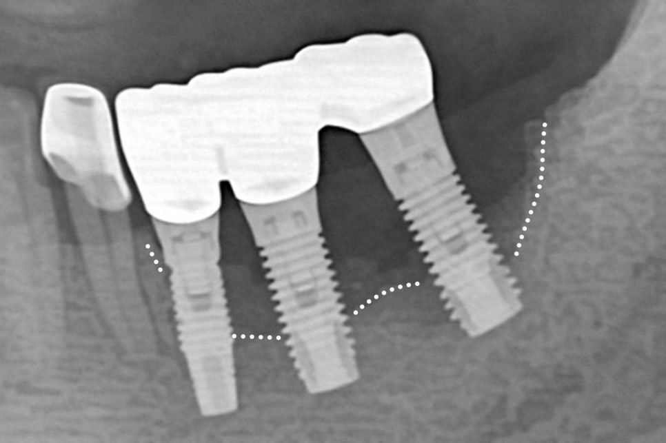 임플란트 관리가 더욱 중요한 이유! 생활 습관으로 달라질 수 있는 보철의 수명 : 당산 치과 관련 이미지 5