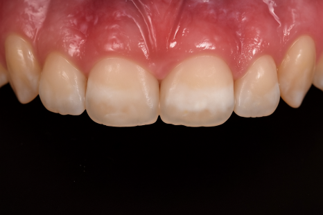 당산역 치과 아이콘 레진이란? : 치아 탈회 및 교정 치료 후 화이트 스팟 관련 이미지 7