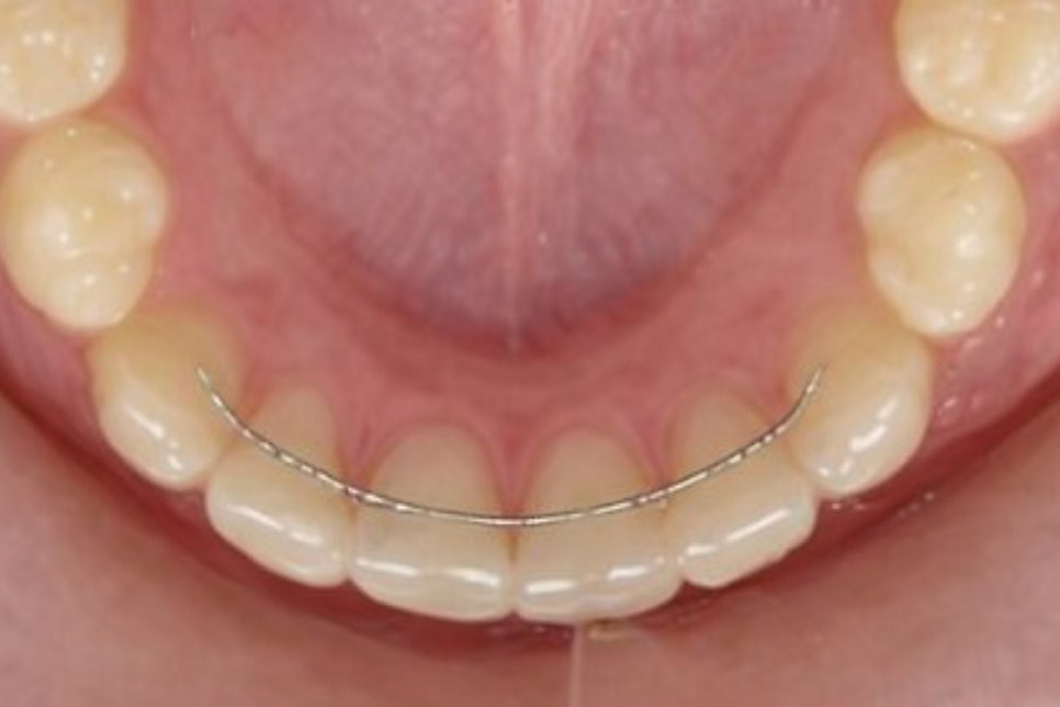 당산 치과 치은연하치석이란? 주기적으로 스케일링 받아야 되는 이유! 관련 이미지 4