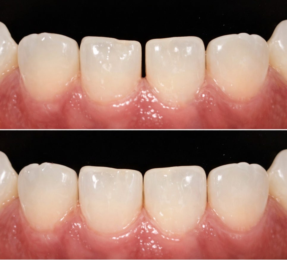선유도역 치과 벌어진 앞니 다이아스테마 diastema 치료 방법 라미네이트 vs 레진 관련 이미지 6