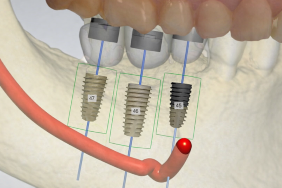 선유도역 치과 네이게이션 임플란트, 어떻게 진행될까? 관련 이미지 5