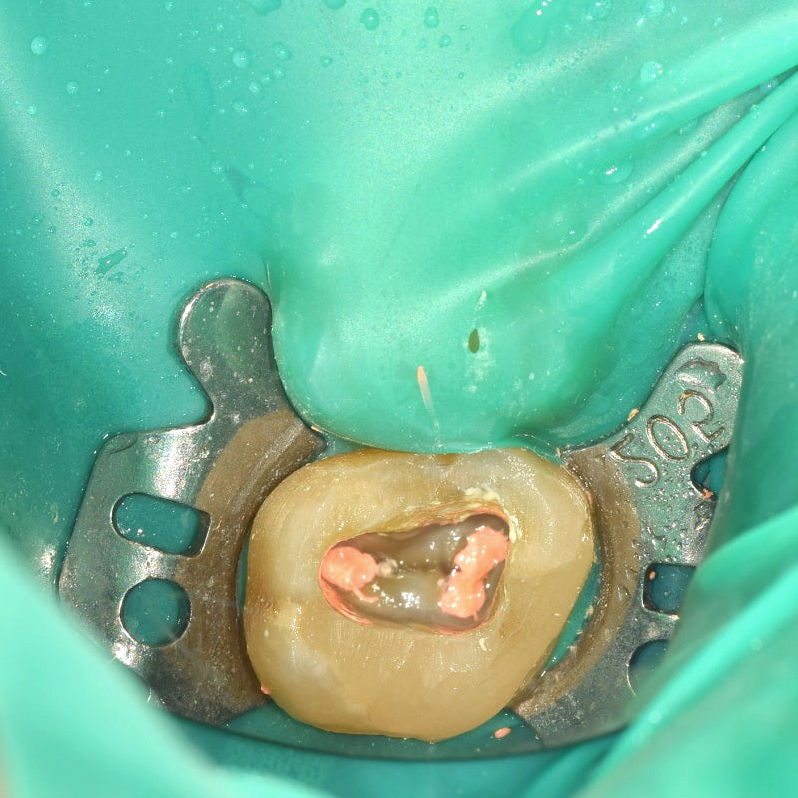 Why the Rubber Dam in Your Mouth Is Essential During Root Canal Treatment at a Dangsan Station Dental Clinic image 1