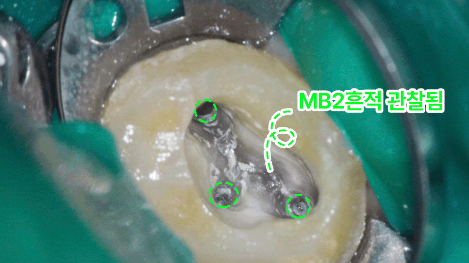 당산동 치과 미세현미경을 활용한 재신경치료 : MB2 근관을 찾아라! 관련 이미지 3