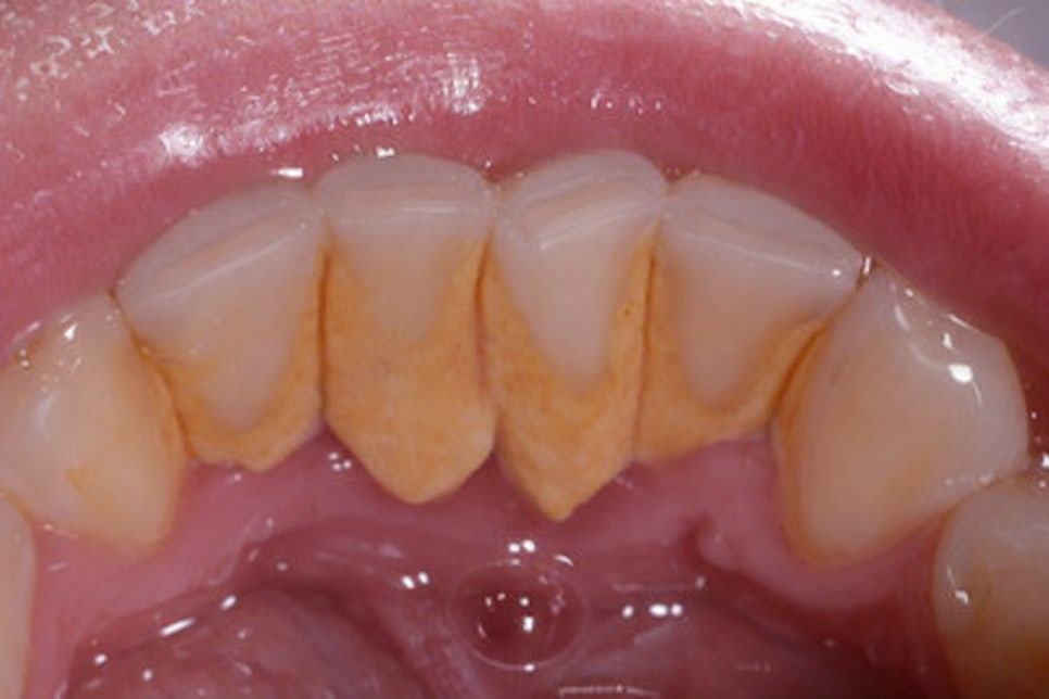 당산동 치과 임산부 치아 치료 시기별 주의해야 될 점 및 보험 혜택 관련 이미지 6