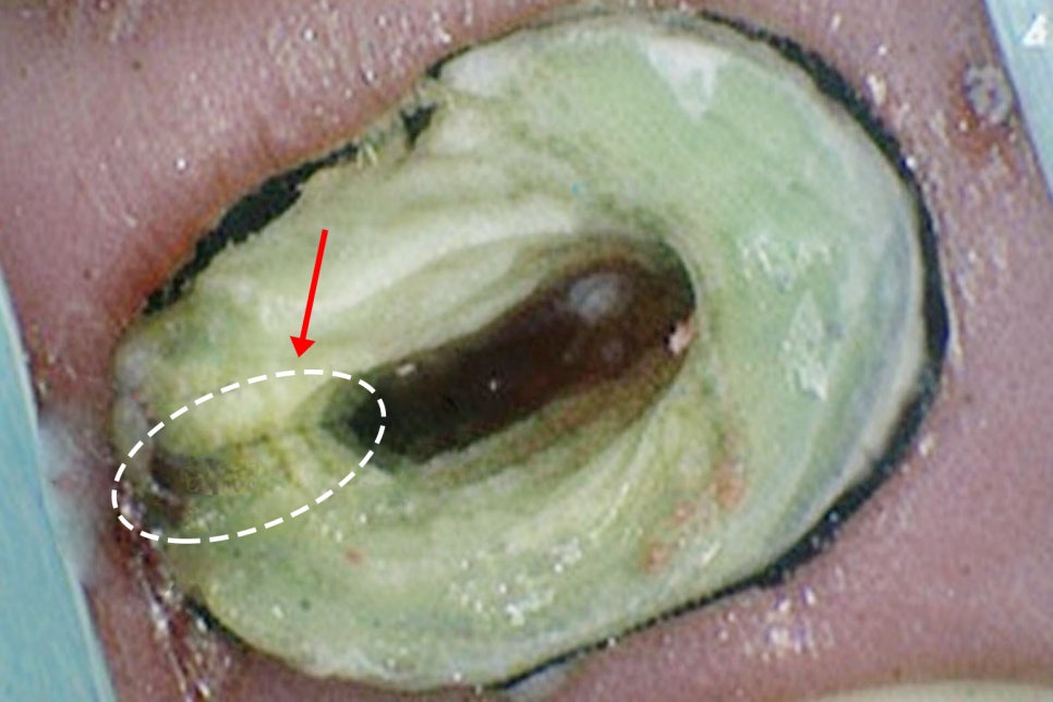 치아 크랙 방치하면 안 되는 이유 파절 증상부터 원인까지 당산 보존치과 에서 알려드립니다! 관련 이미지 2