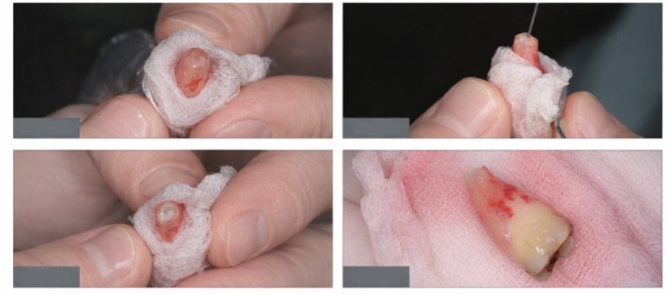 선유도 치과 에서 알려드리는 발치 전 자연치 살리는 마지막 치료 방법 치아재식술 관련 이미지 5