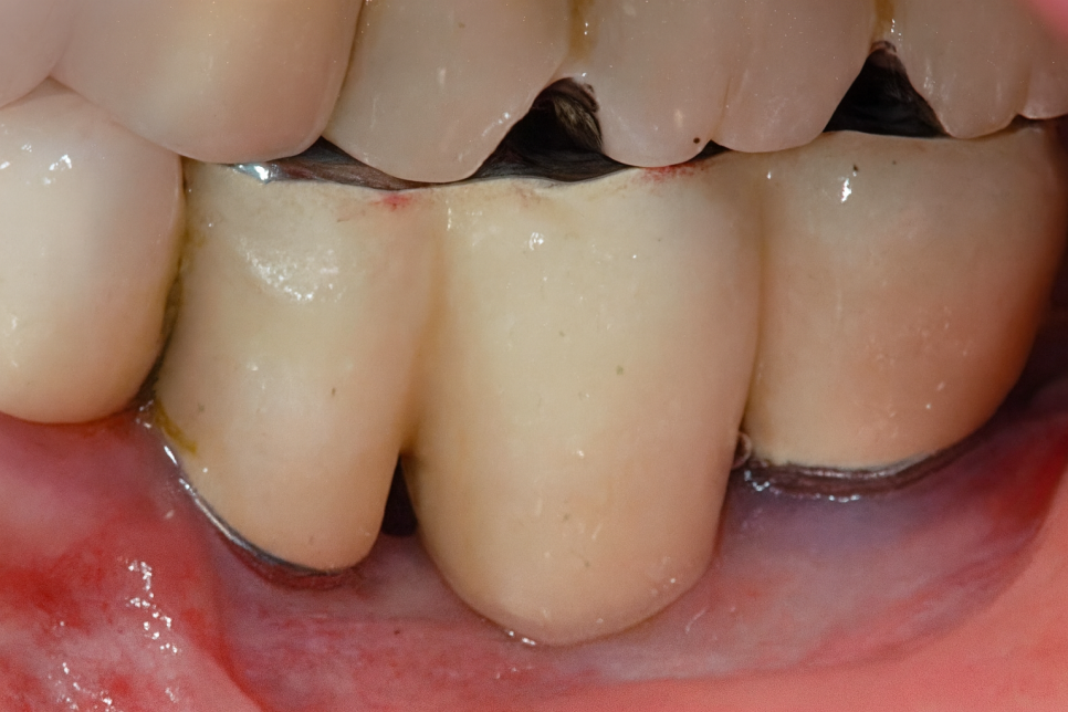 선유도역 치과 임플란트 수명은 잇몸이 결정한다?! Ft. 부착치은 관련 이미지 2