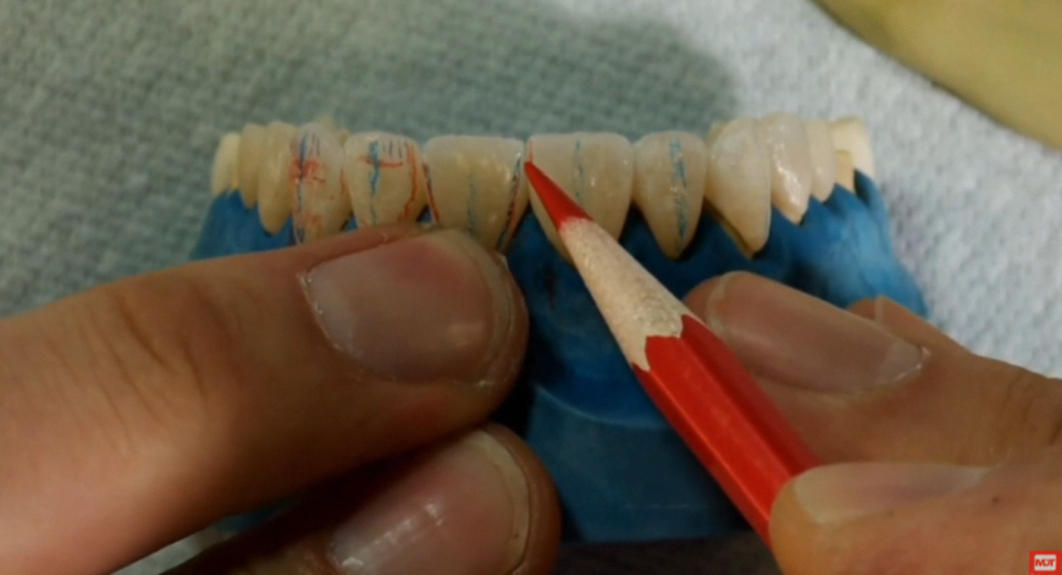 The Process of Creating Aesthetic Prosthetics Using a 3D Oral Scanner at the National Assembly Building Dental Clinic! image 9