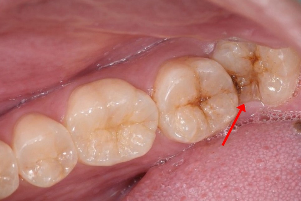 수평 매복 사랑니 예방적 발치가 필요할 때는? 선유도역 치과 Ft. 인접치 우식 & 치조골 흡수 등 관련 이미지 4