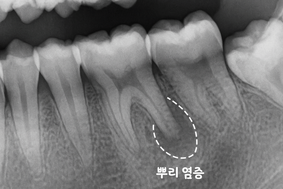 연세초록빛 치과 , 치아 진료 시 환자들이 궁금해하는 질문: 엑스레이(X-ray) 촬영은 왜 필요할까? 관련 이미지 4