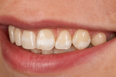 당산역 치과 아이콘 레진이란? : 치아 탈회 및 교정 치료 후 화이트 스팟 관련 이미지 9