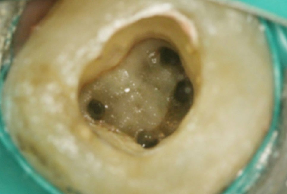 선유도 치과 재신경치료! 점점 커지는 치아 뿌리 염증 잡는 방법 관련 이미지 3