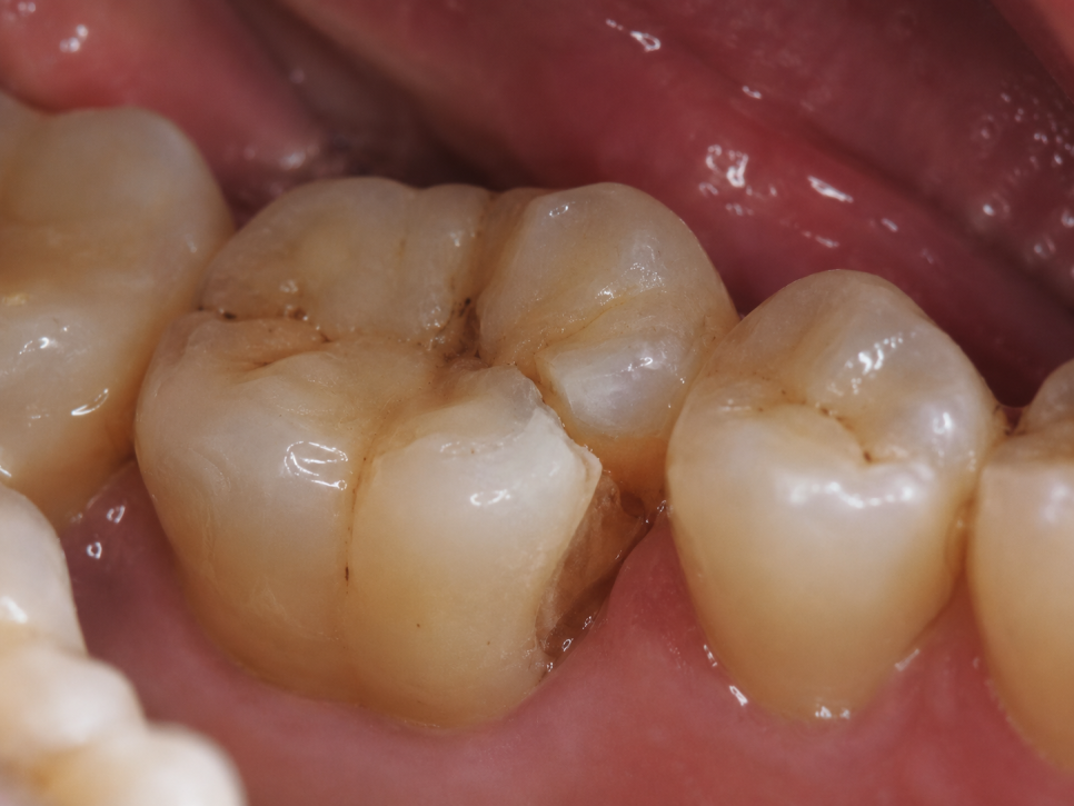 Does a Tooth Fracture at a Dangsan-dong Dental Clinic Always Require Root Canal Treatment? image 7