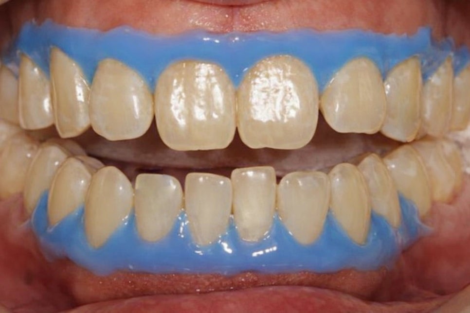 하얀 치아를 가지고 싶다면? 당산역 미백 치과 와 알아보는 시술 과정 관련 이미지 3