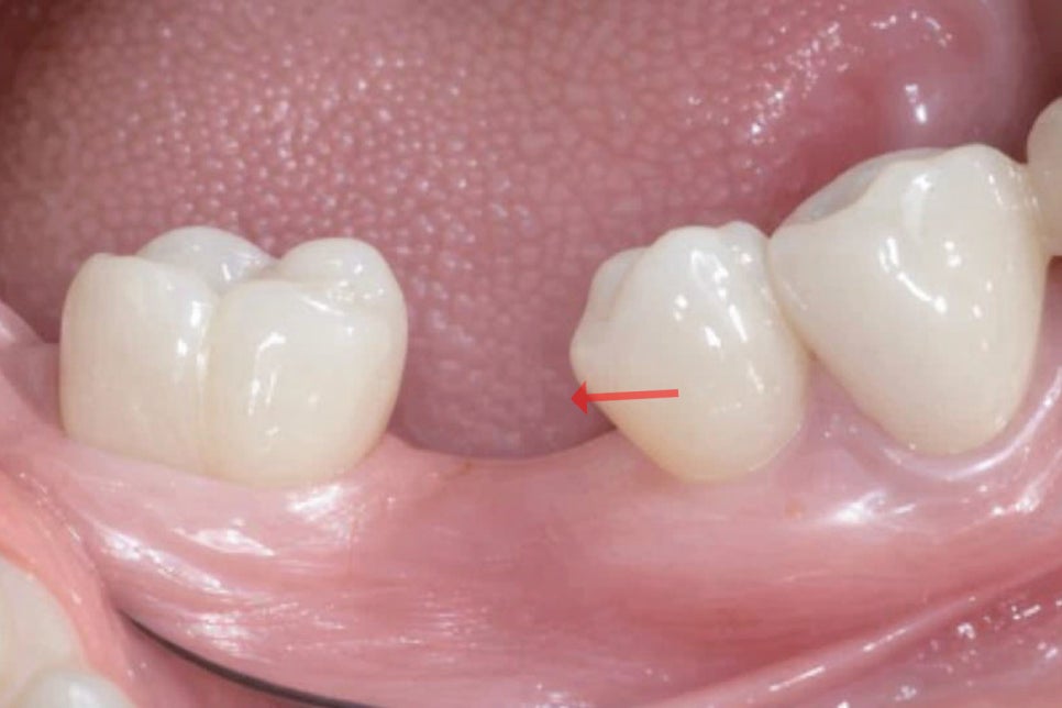 영등포구청역 치과 치아 상실 시 발생할 수 있는 구강 내 문제점은 무엇이 있을까? 관련 이미지 5